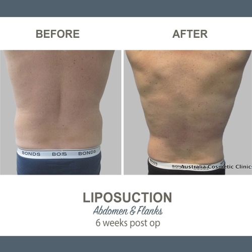 Liposuction Before and After Photos 8-1 Abdomen and Flanks