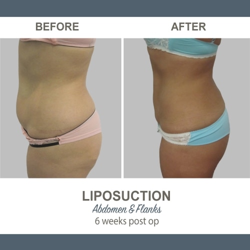 Liposuction Before and After Photos 9-1 Abdomen and Flanks