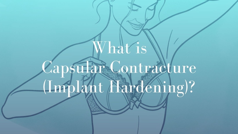 What is Capsular Contracture (Implant Hardening) - Image Mark Kohout