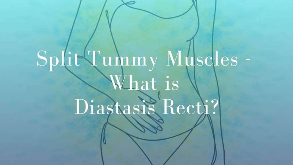 Split Tummy Muscles - What is Diastasis Recti