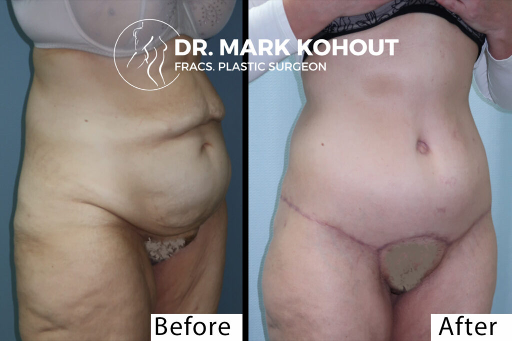 Abdominoplasty Recovery Time