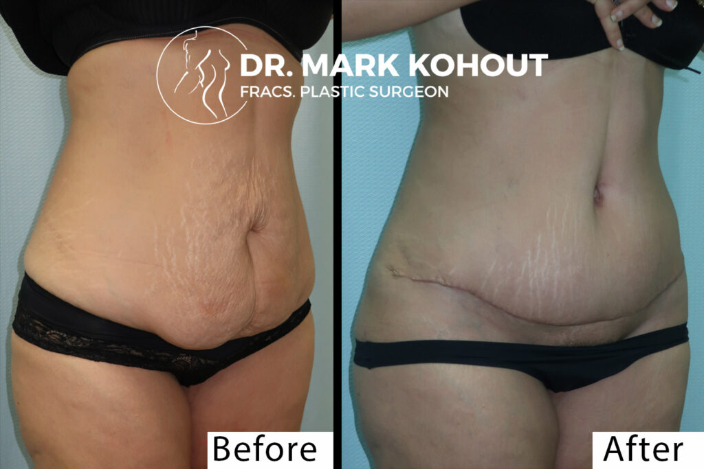 Abdominoplasty Recovery Time