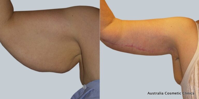 Arm-Reduction-2-14-from-Acc