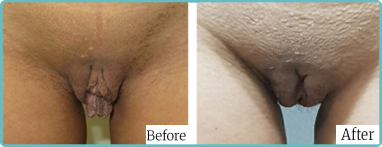 Labioplasty by Dr Mark Kohout Sydney 004