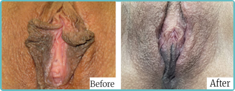 Labioplasty by Dr Mark Kohout Sydney 005