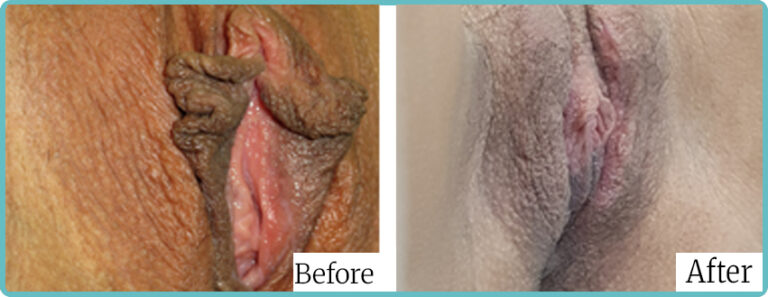 Labioplasty by Dr Mark Kohout Sydney 006