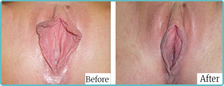 Labioplasty by Dr Mark Kohout Sydney 007