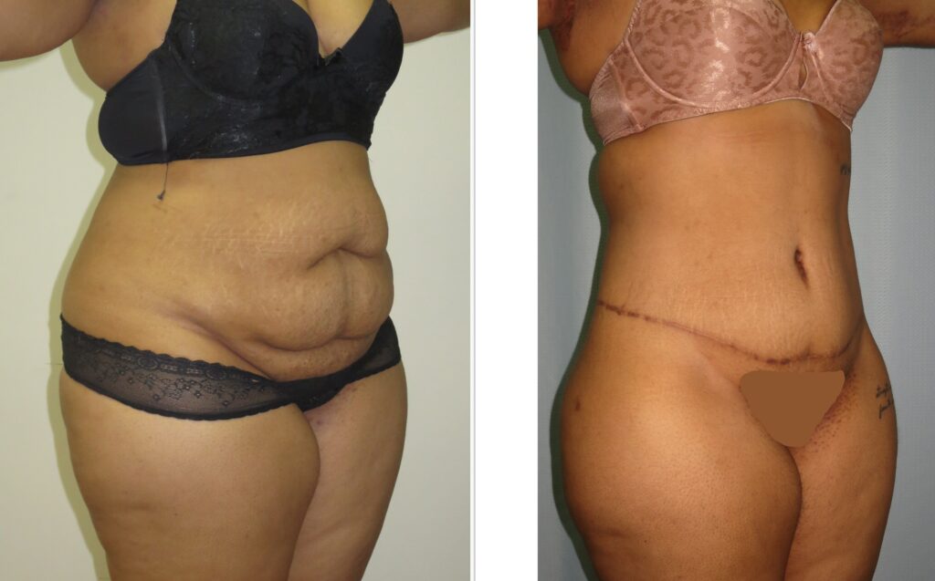 Body Lift Before and After