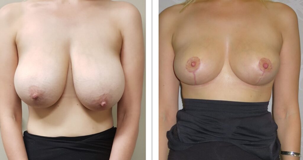 Breast Reduction Before and After