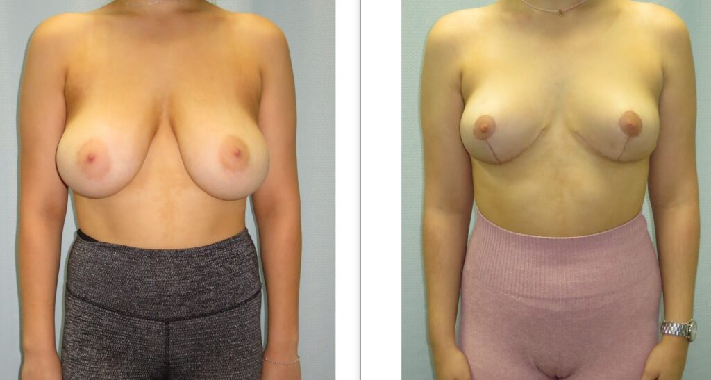 Breast Reduction Before and After