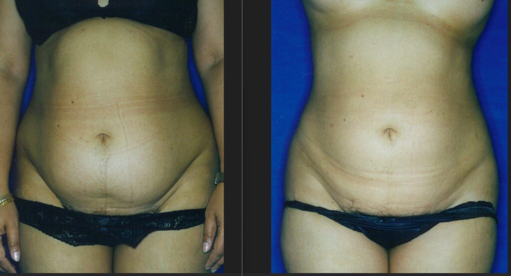 Liposuction Before and After - Abdomen