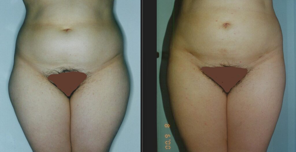 Liposuction Before and After - Abdomen and Thighs