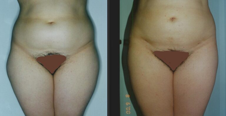 Liposuction Before and After - Abdomen and Thighs