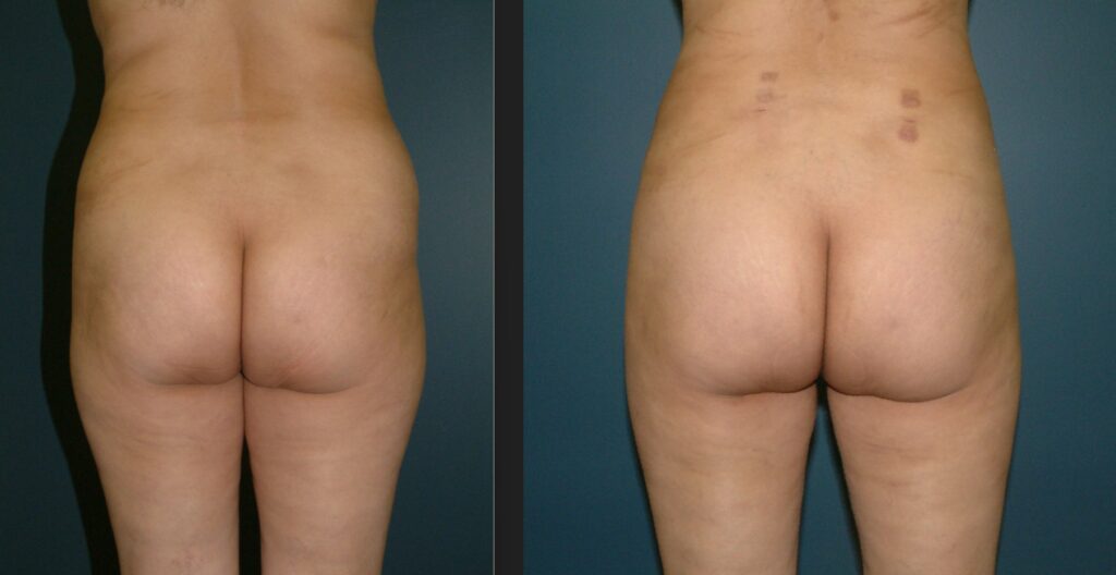 Liposuction Before and After - Flanks