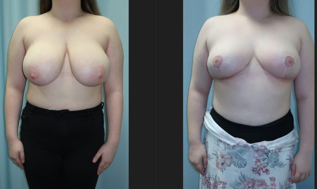 Breast Reduction Before and After
