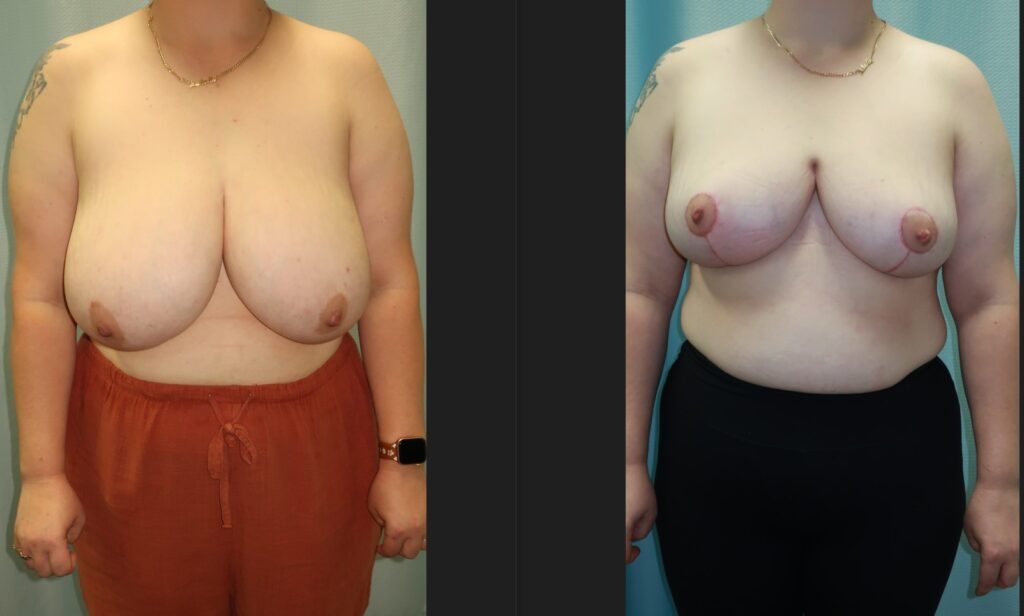 Breast Reduction Before and After