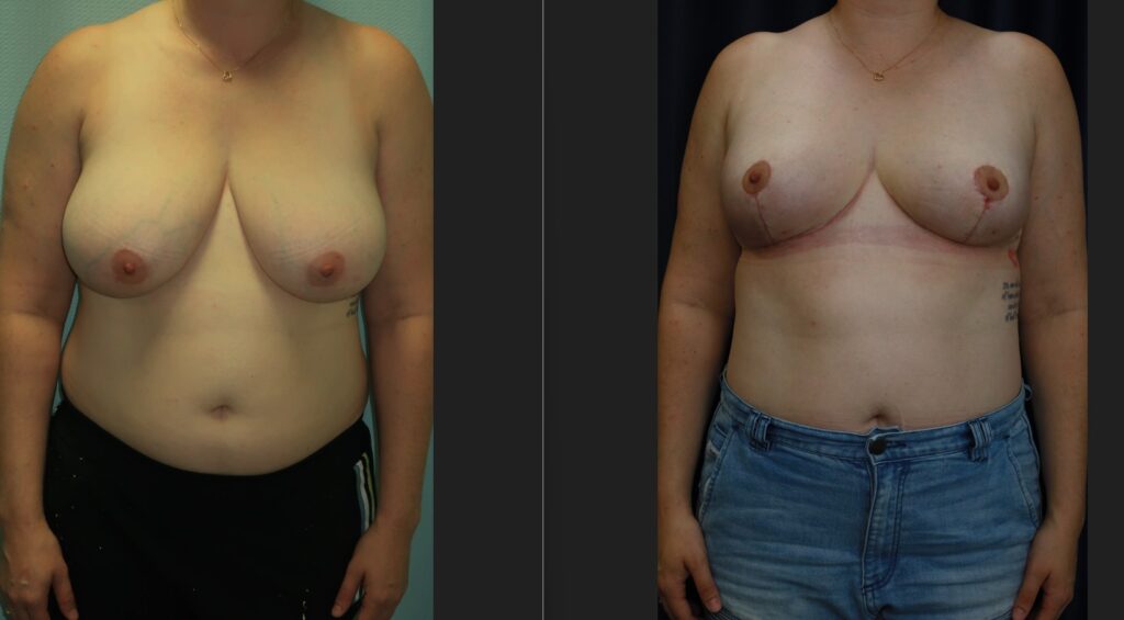Healing and Recovery After Breast Reduction Surgery