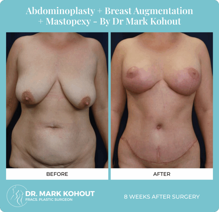 Dr. Mark Kohout, Before-After-Abdominoplasty-Breast-Augmentation-Mastopexy-Patient