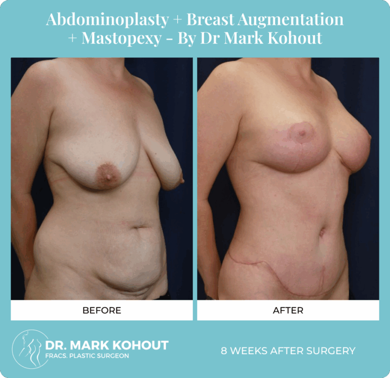 Dr. Mark Kohout, Before-After-Abdominoplasty-Breast-Augmentation-Mastopexy-Patient