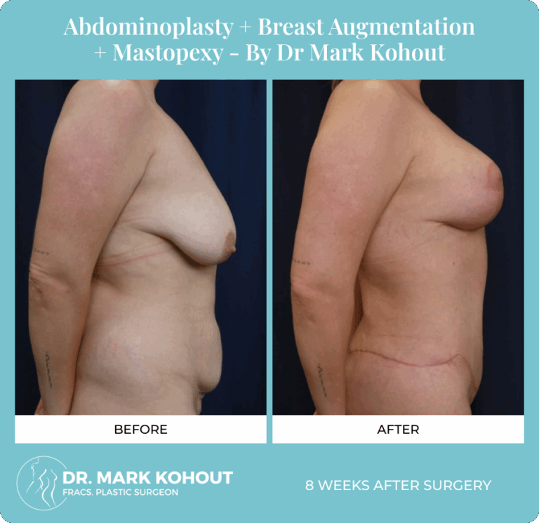Dr. Mark Kohout, Before-After-Abdominoplasty-Breast-Augmentation-Mastopexy-Patient
