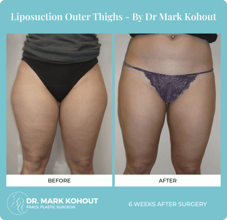 Dr. Mark Kohout Before-After Liposuction Patient