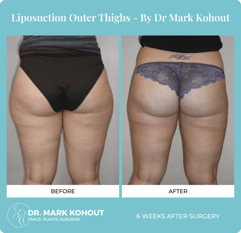 Dr. Mark Kohout Before-After Liposuction Patient