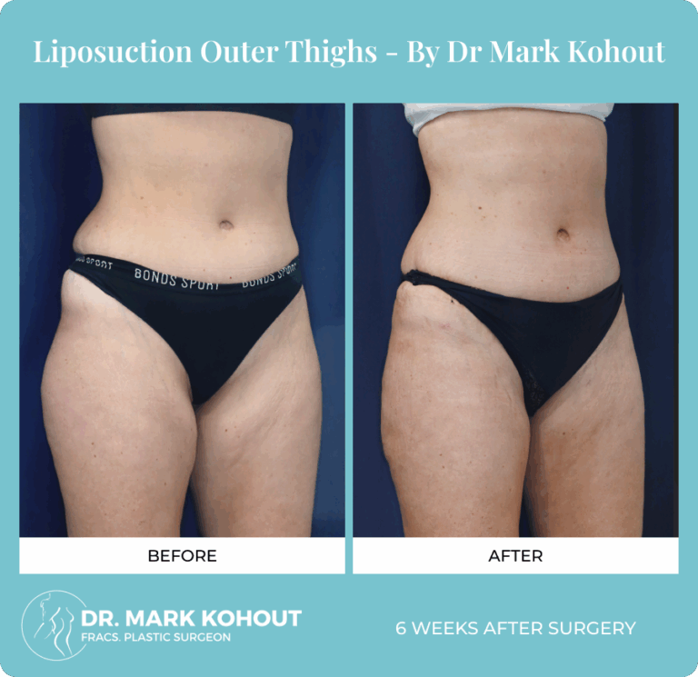 Dr. Mark Kohout Before-After Liposuction Patient