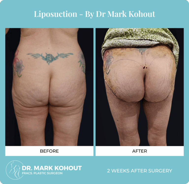 Dr. Mark Kohout Before-After Liposuction Patient