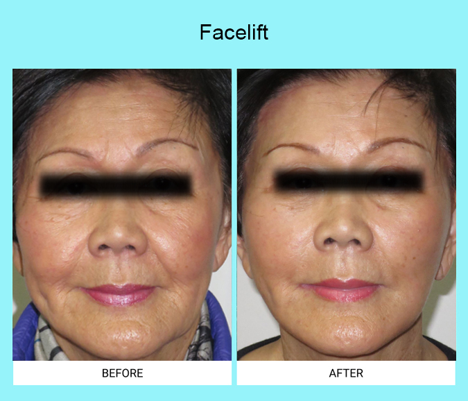 Facelift-Patient-10-front