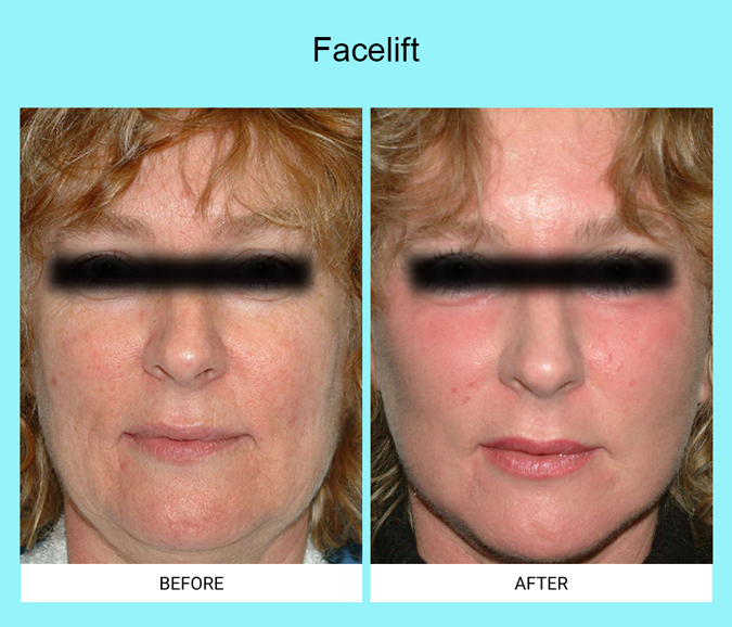 Facelift-Patient-12-front