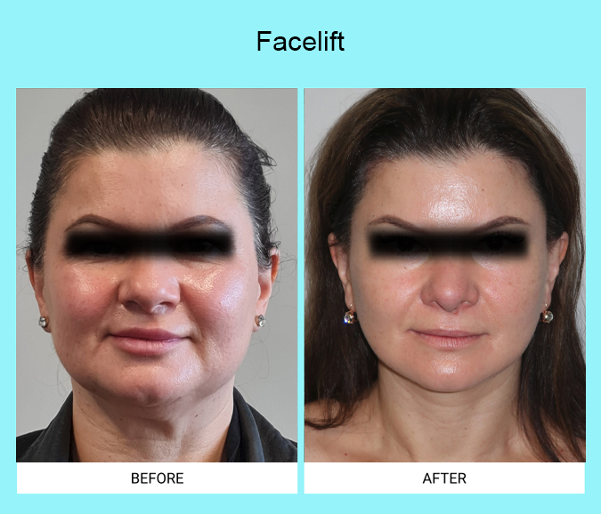 Facelift-Patient-15-front