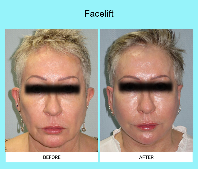 Facelift-Patient-16-front