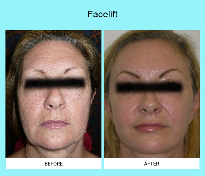 Facelift-Patient-2-front