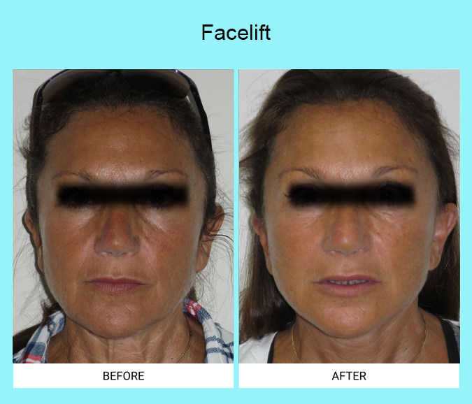 Facelift-Patient-3-front