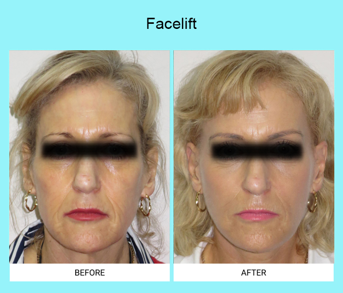 Facelift-Patient-4-front