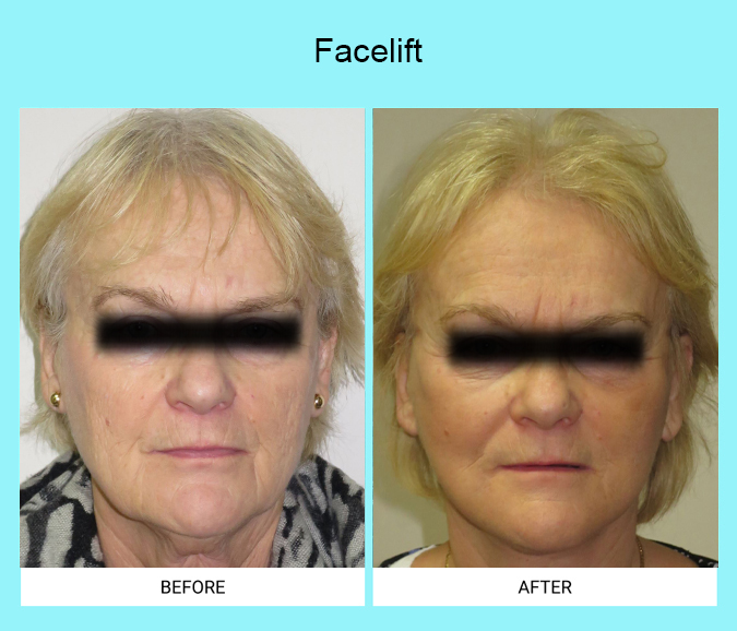 Facelift-Patient-6-front