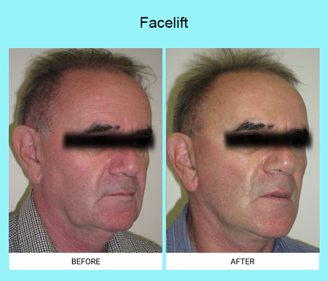 Facelift-Patient-7-45