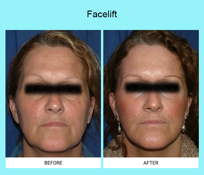 Facelift-Patient-9-front