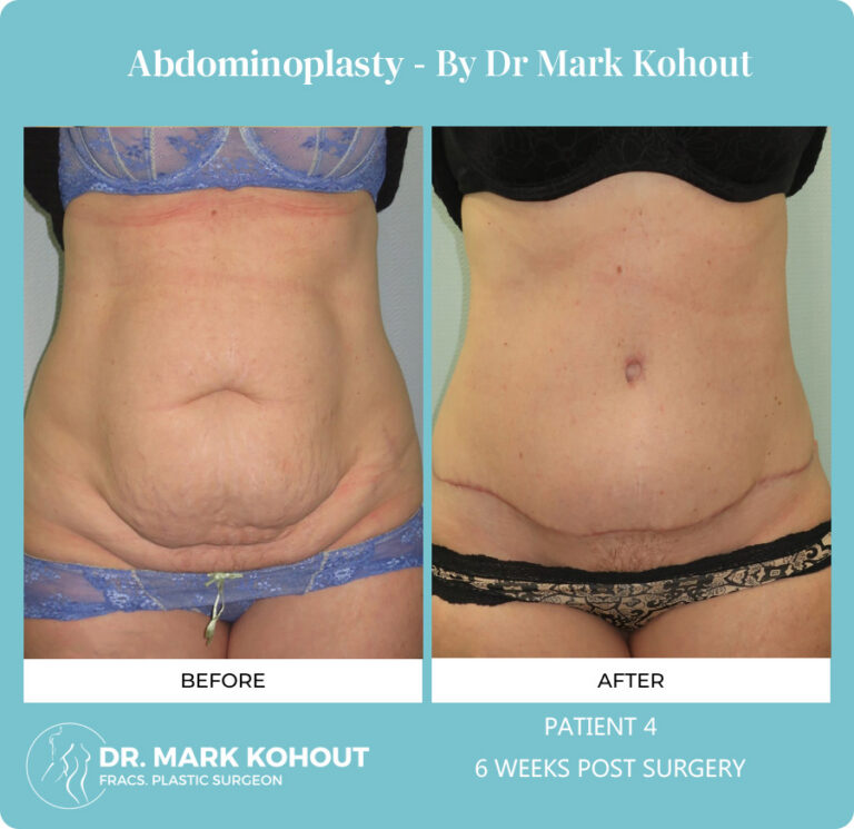 Abdomino Plasty Before and After Photos