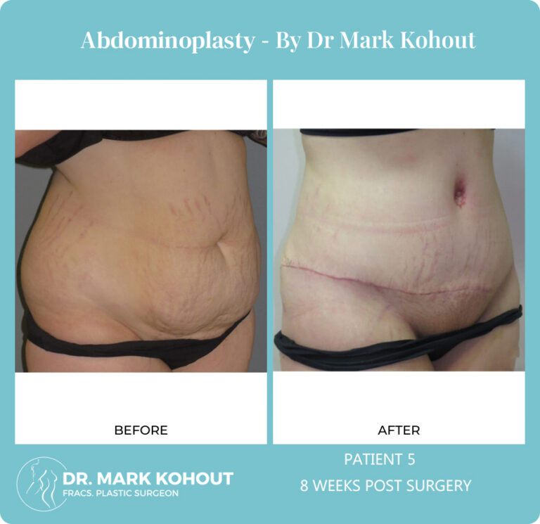 Abdomino Plasty Before and After Photos