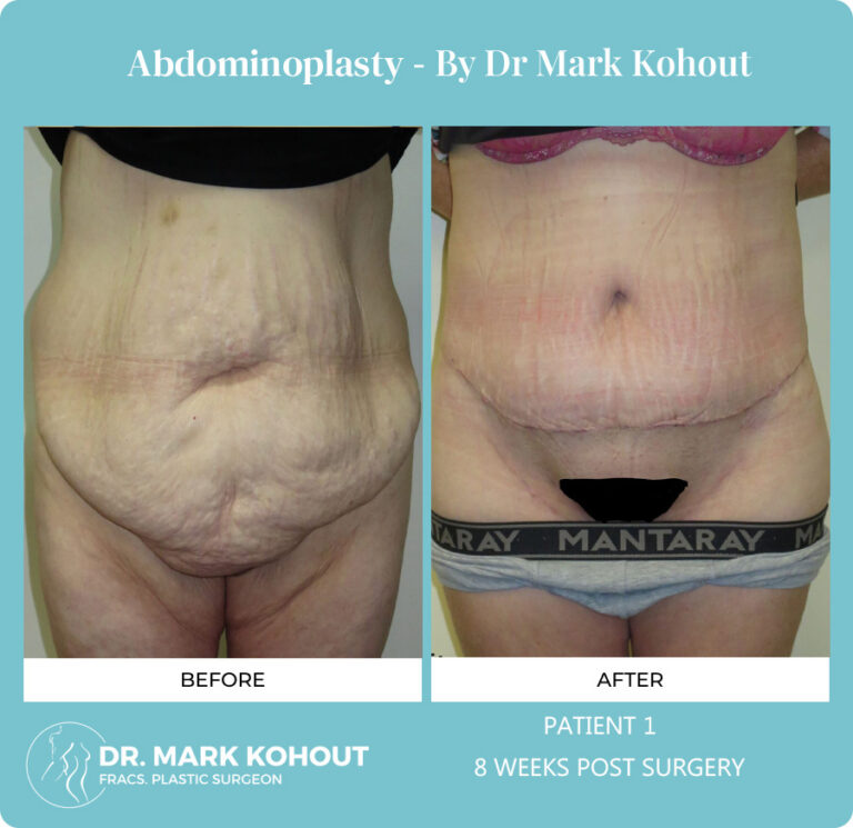 Abdominoplasty Before and After Photos