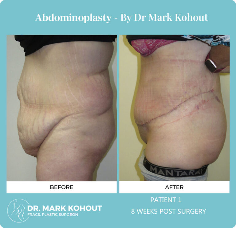 Abdominoplasty Before and After Photos