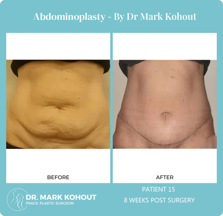 Abdominoplasty Before and After Photos