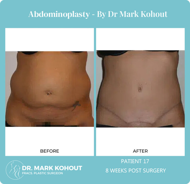Abdominoplasty Before and After Photos