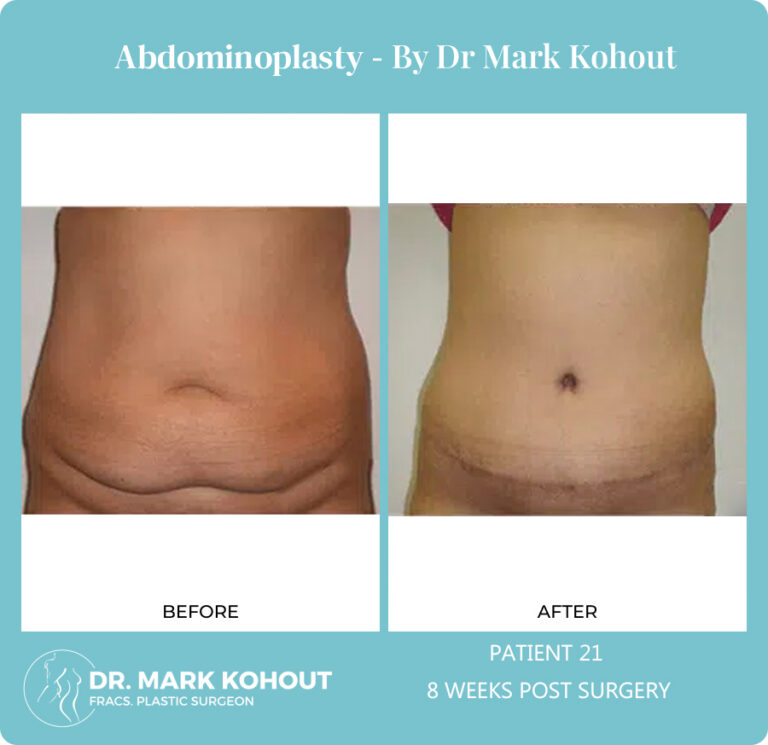 Abdominoplasty Before and After Photos