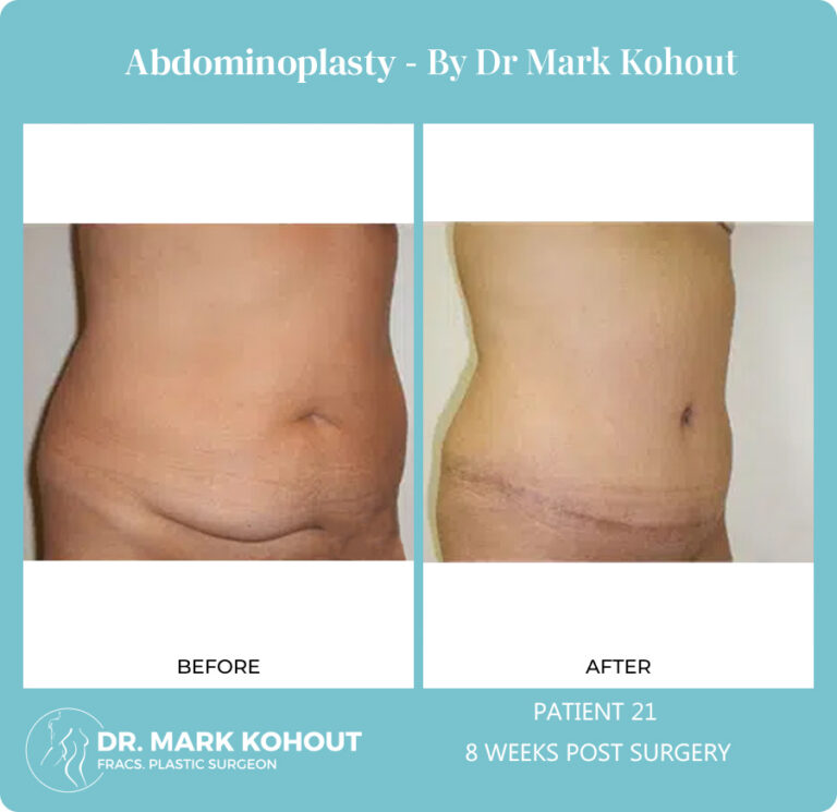 Abdominoplasty Before and After Photos