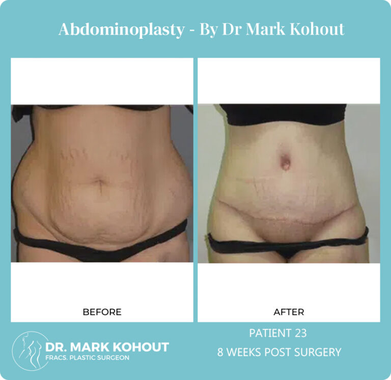 Abdominoplasty Before and After Photos