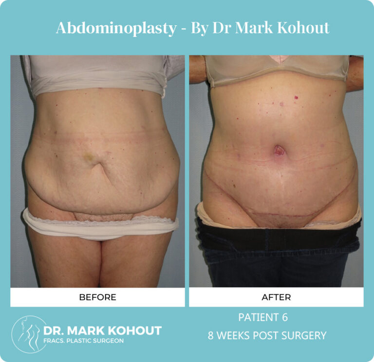 Abdominoplasty Before and After Photos