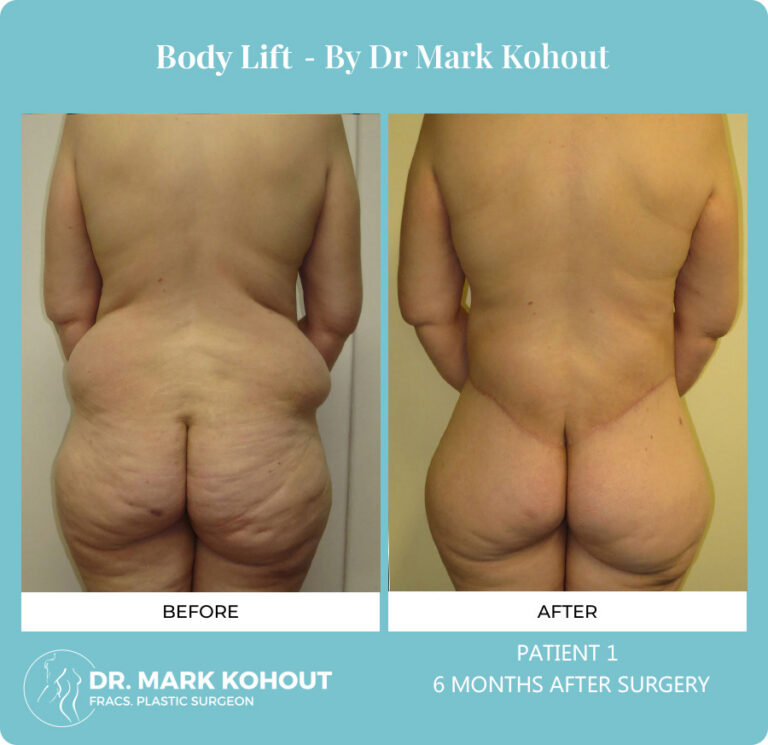 Body Lift Before and After Photos