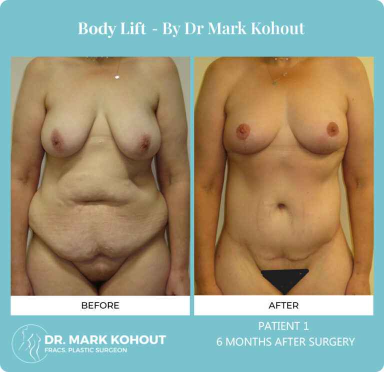 Body Lift Before and After Photos